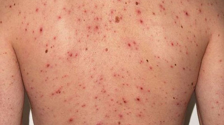 Cu&aacute;les son los s&iacute;ntomas del sarampi&oacute;n y por qu&eacute; el Gobierno emiti&oacute; un alerta