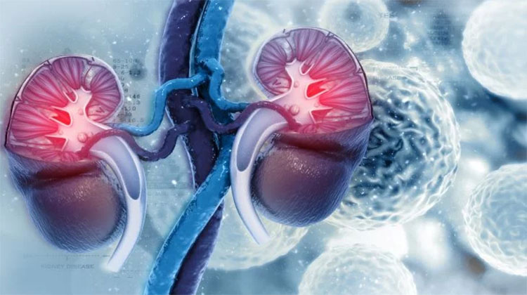 D&iacute;a Mundial del C&aacute;ncer de Ri&ntilde;&oacute;n