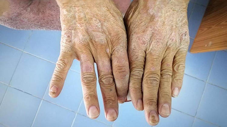 D&iacute;a Mundial de la Esclerodermia