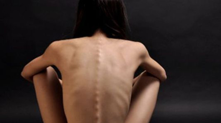 Anorexia nerviosa o Tane restrictivo